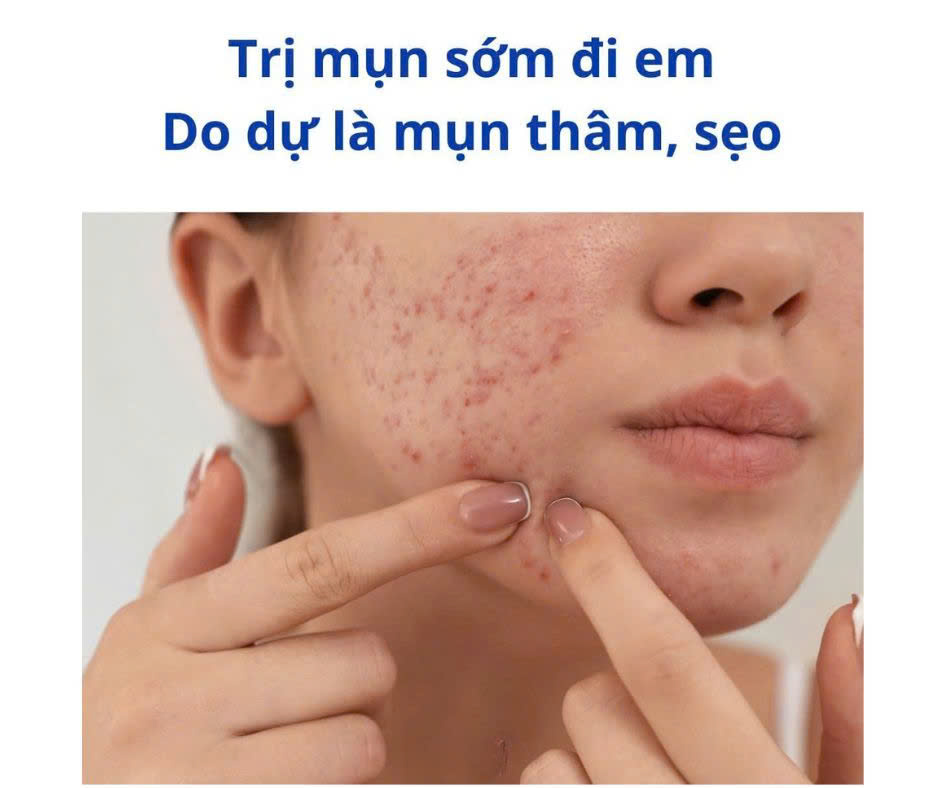 ĐIỀU TRỊ MỤN